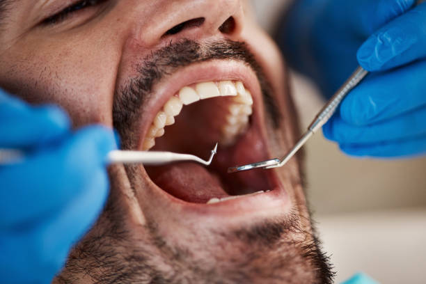 Full Mouth Reconstruction in Hudson Oaks, TX